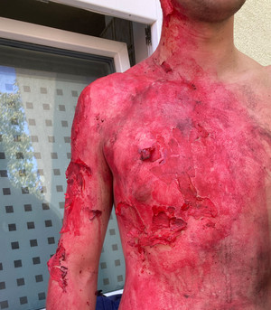 Bei der Johanniter-Station in Orth/Donau wurde ein Grillunfall nachgestellt - mit realistisch geschminkten Statisten, die Verbrennungsopfer darstellten.